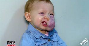 Zij werd als baby geboren met een tumor op haar gezicht. Maar let op haar transformatie na 10 operaties!