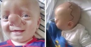 Peuter wordt ‘Pinocchio’ genoemd en laat z’n neus opereren. Kijk hem 3 jaar later eens..