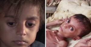 Kleine Hassan uit Jemen wordt geholpen na schokkende foto die de wereld overging