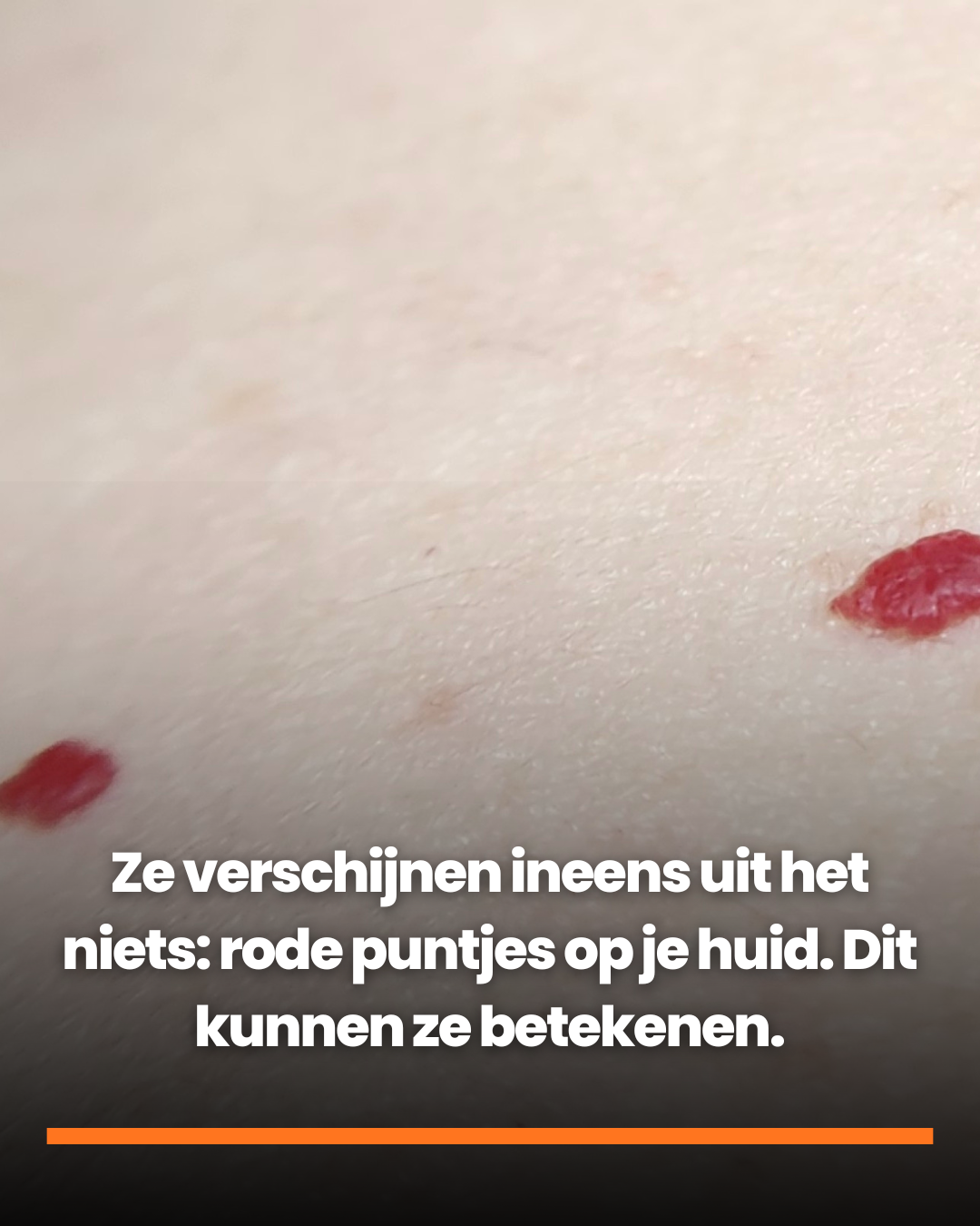 ze-verschijnen-ineens-uit-het-niets-rode-puntjes-op-je-huid-dit